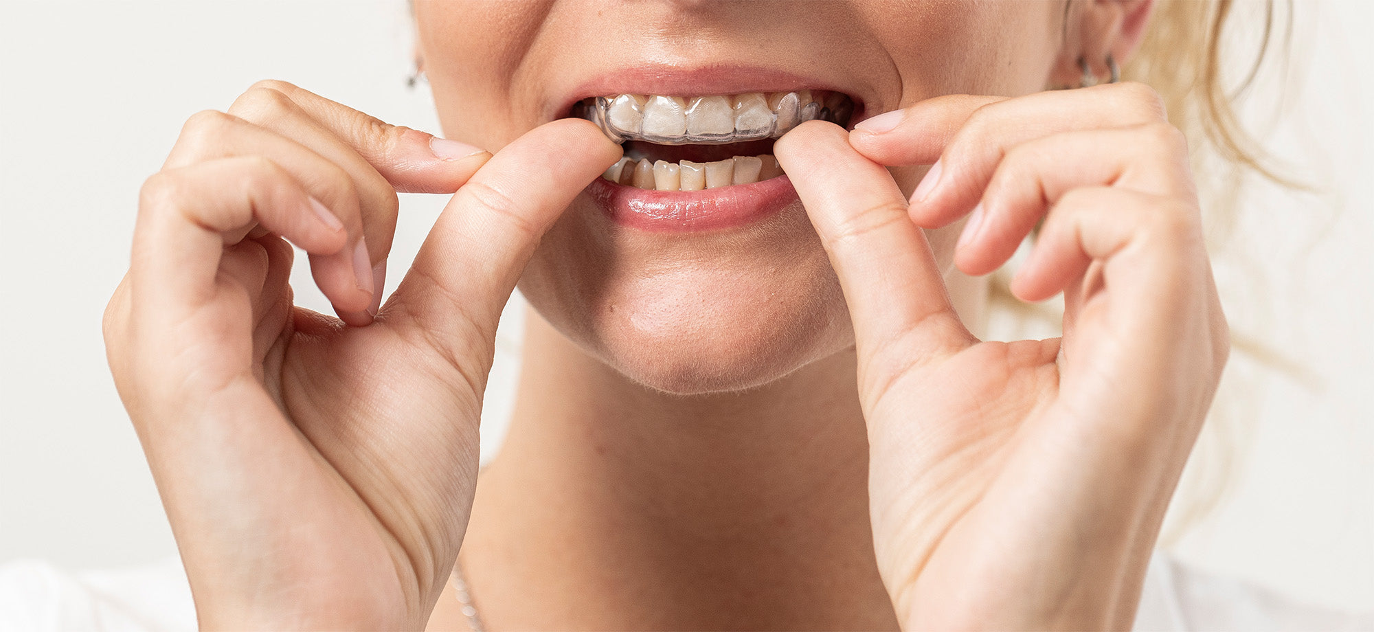 DMG Luxaprint Ortho Plus Dental 3D Resin Beispiel 2